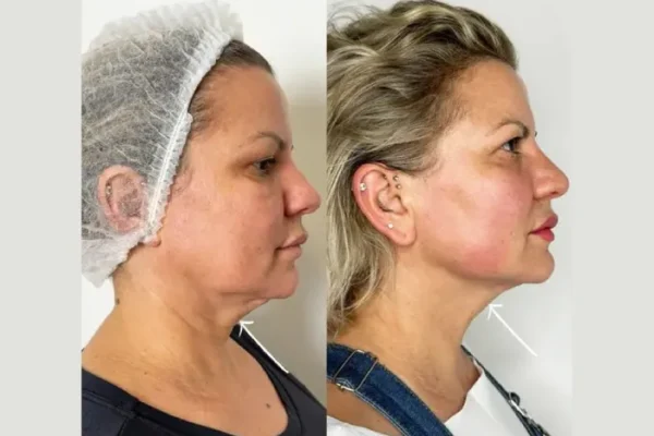 The Complete Guide to Endolift in Dubai for First-Time Patients Endolift in Dubai