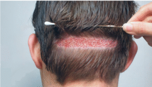 Hair Transplant in Pakistan