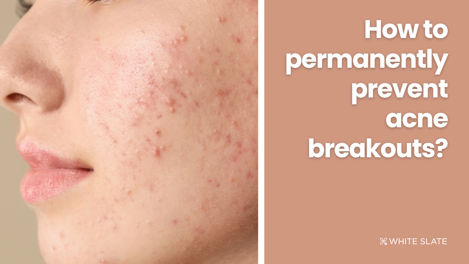 Acne Breakouts