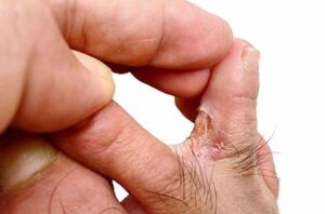Eczema and Ringworm