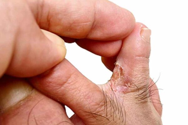 Eczema and Ringworm