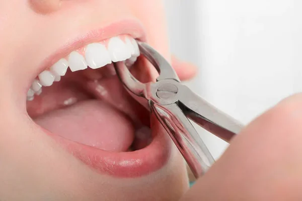 Teeth Extractions