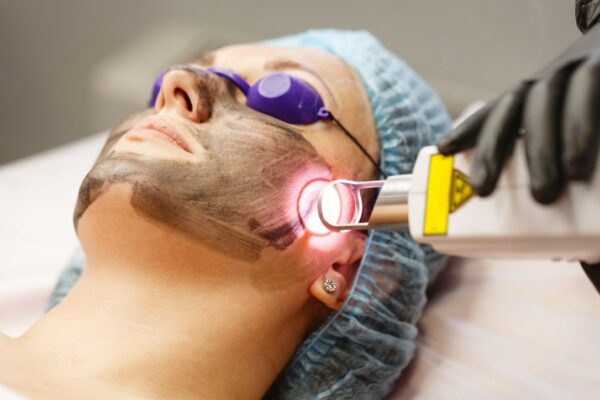 Carbon Laser Peel Treatment