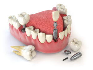 dental implants in mumbai