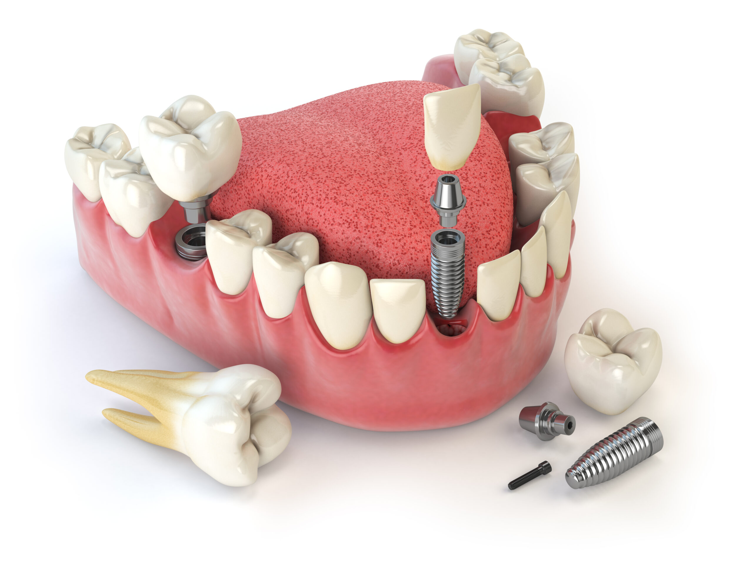 dental implants in mumbai