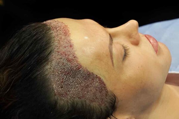 FUE Hair Transplant in Islamabad