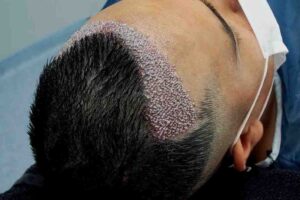 FUE Hair Transplant in Islamabad