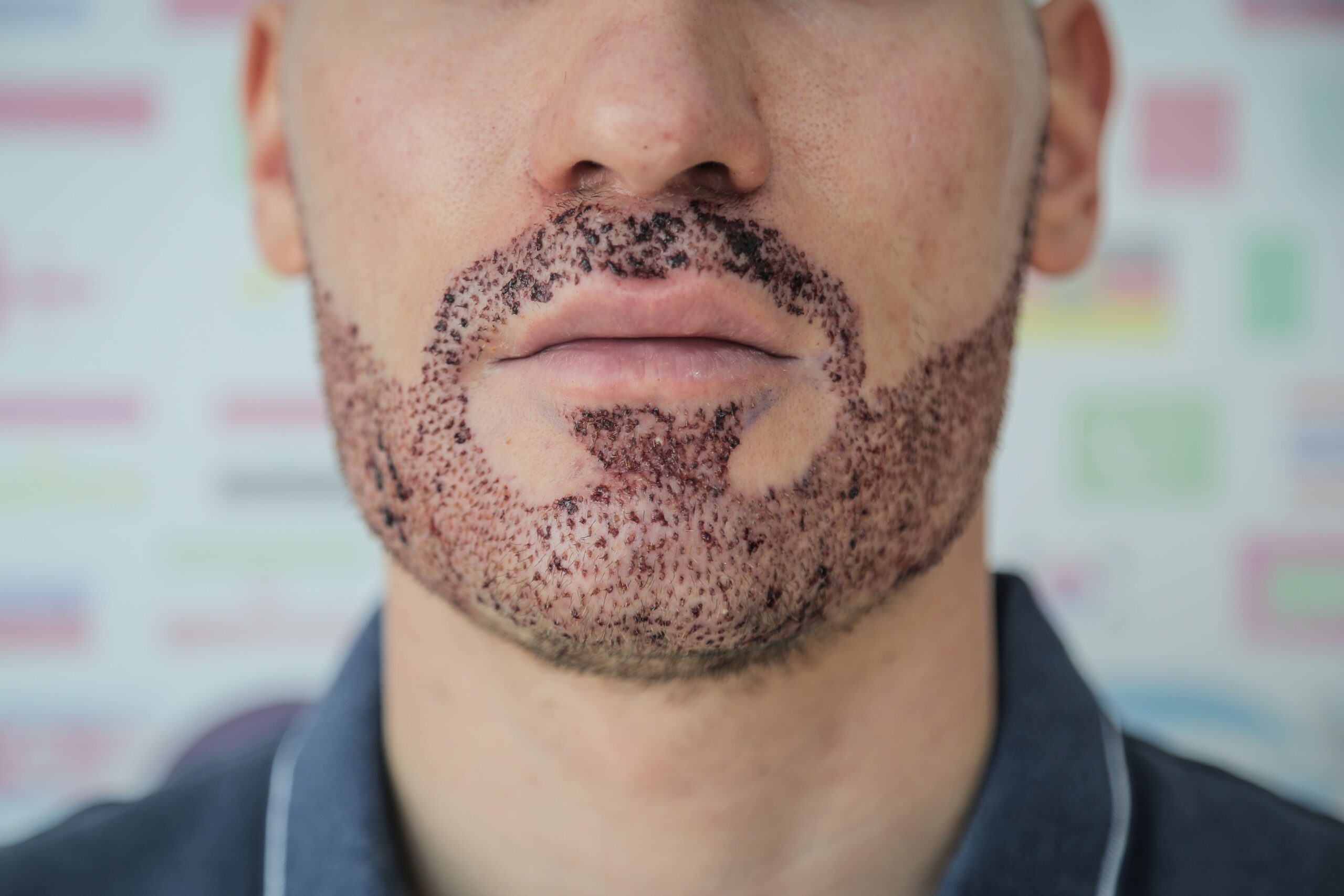 beard hair transplant in Islamabad