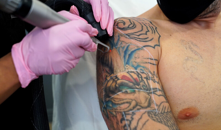 tattoo removal essex