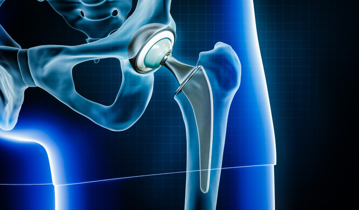 Revision Hip Replacement Surgeon in Delhi