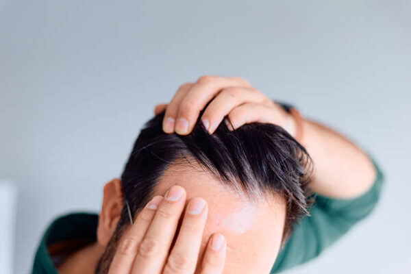 exosome therapy for hair loss in riyadh