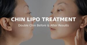 chin lipo