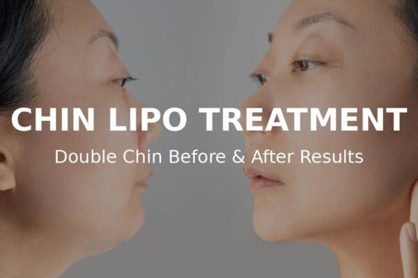 chin lipo