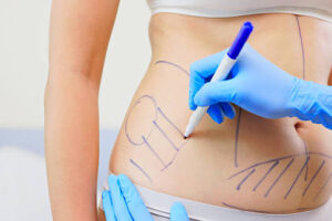 liposuction in riyadh