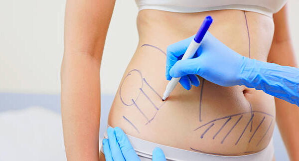 liposuction in riyadh