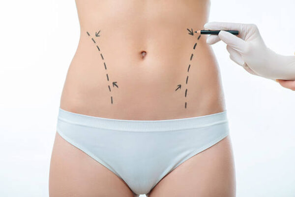 Liposuction in Riyadh