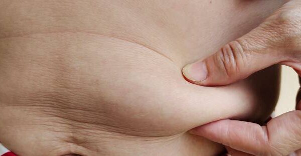 Tummy Tuck in Riyadh