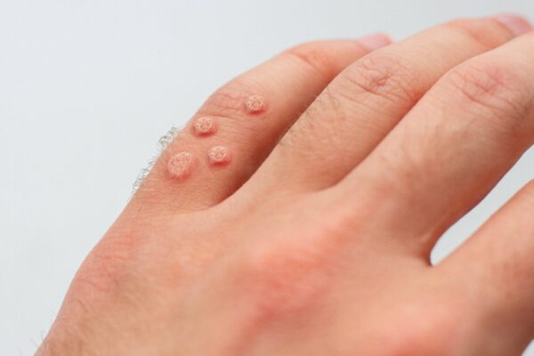 Warts removal treatment in Islamabad Pakistan