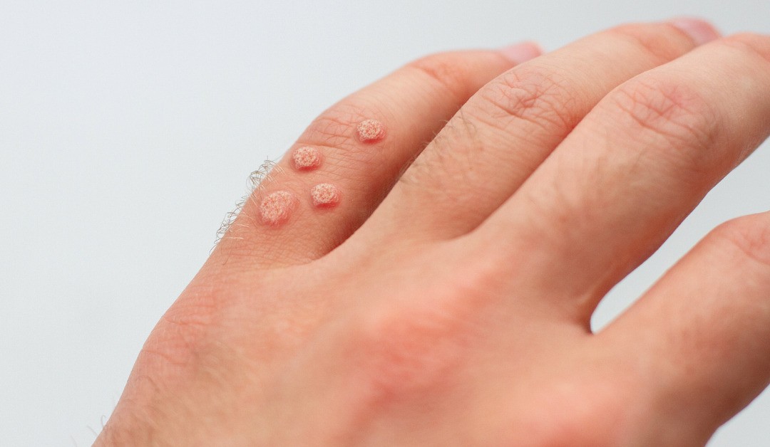 Warts removal treatment in Islamabad Pakistan