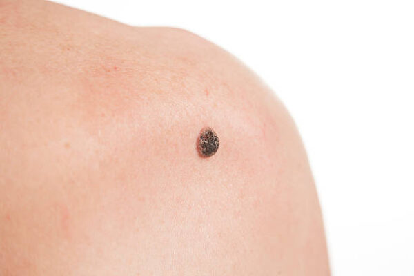 إزالة الثآليل في الرياض